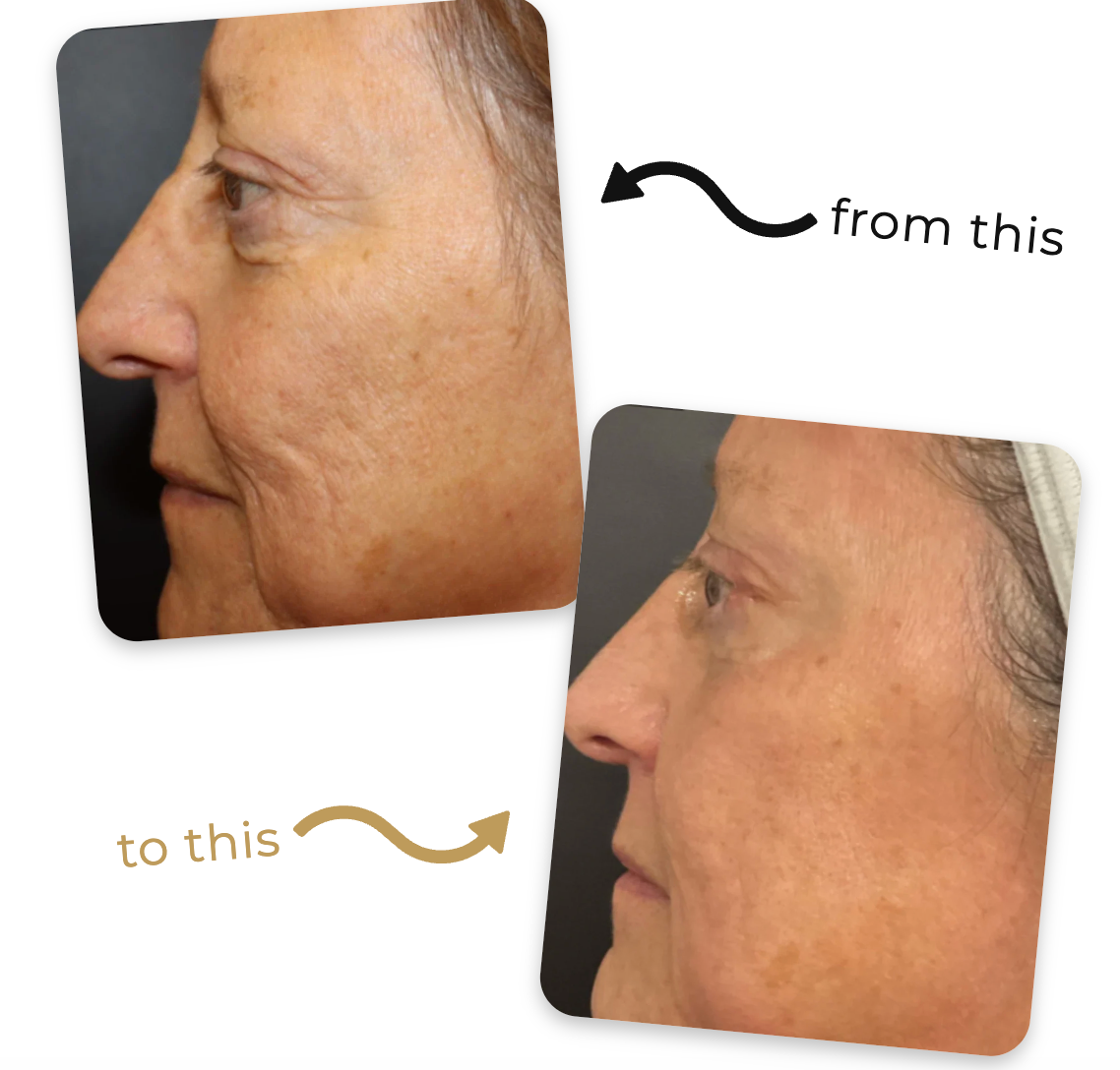 Deep Collagen Lifting Peptide